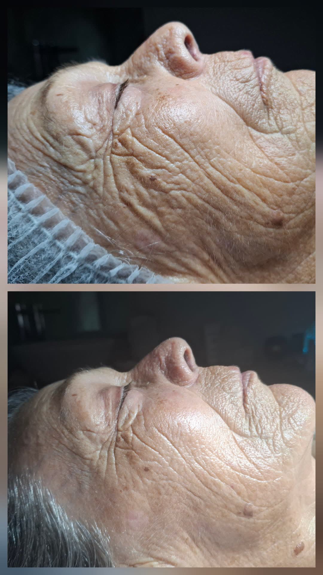 Trattamento Antiage — Prima e Dopo